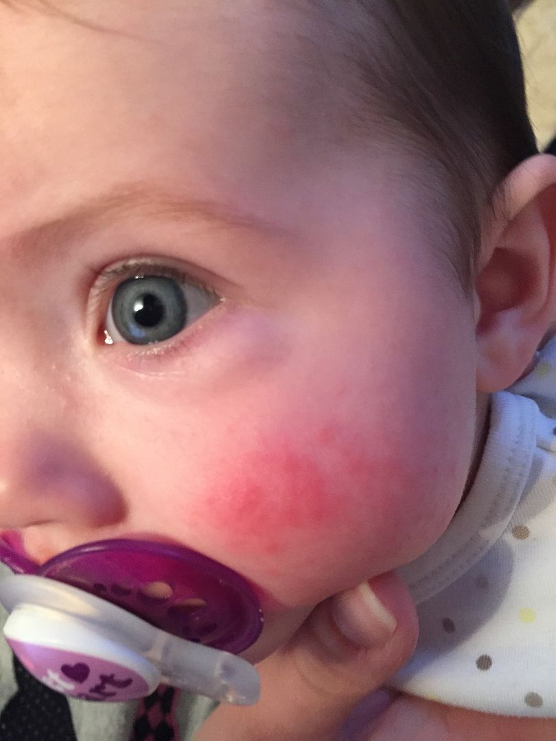 Baby Has Rash On Face What Could It Be Pic Babycentre